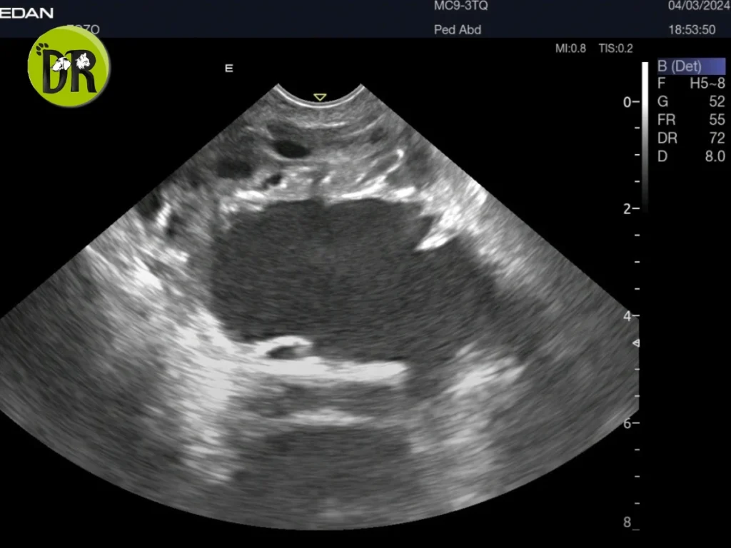 Testicular Tumor - Cryptorchid Testicle Resection 1 Orchidectomy 1